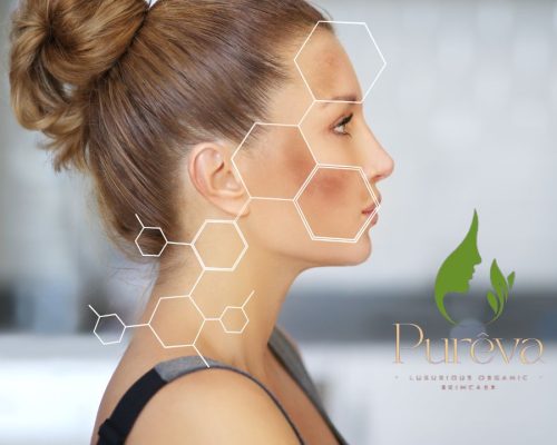 Hyperpigmentation Hyperpigmentation