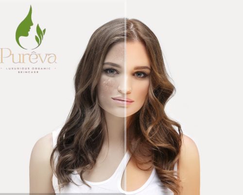 Hyperpigmentation_women Hyperpigmentation_women